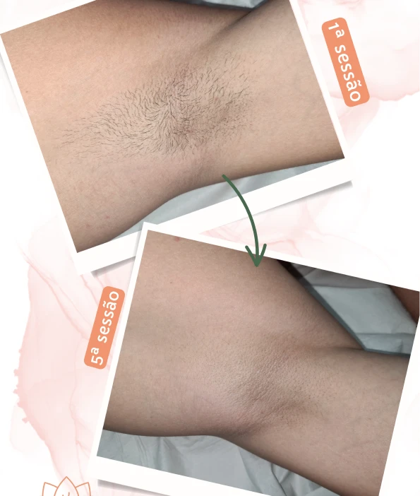 axilas_masculinas_01